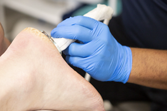 foot pain treatment at Cheshire clinic